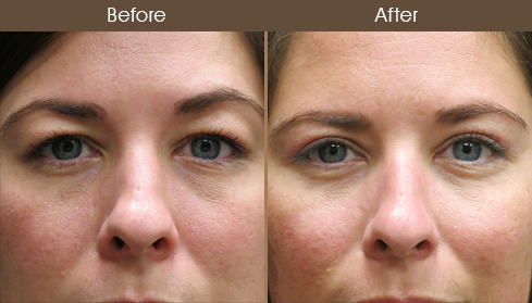 Blepharoplasty Before And After